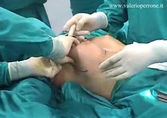 ,Breast Furthermore transaxillary, prima e dopo, mastoplastica additiva per via ascellare - YouTube